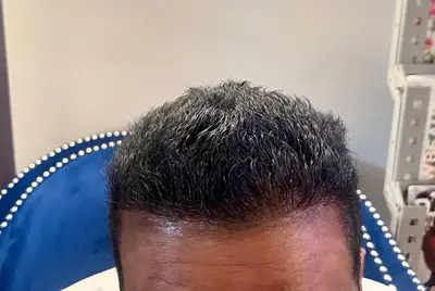 Hair restoration patient after treatment — healed result