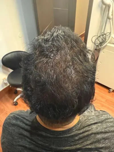 Hair restoration patient after treatment