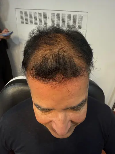 Hair restoration patient before treatment — top view