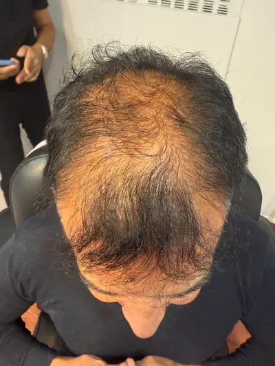 Hair restoration patient before treatment